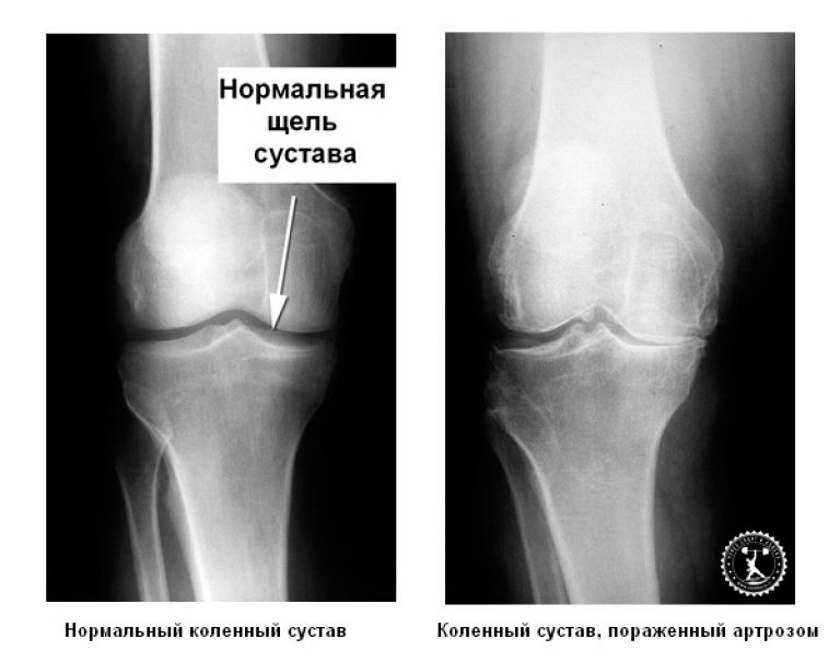 Рентген коленного сустава при артрозе Рентген коленного сустава при артрозе